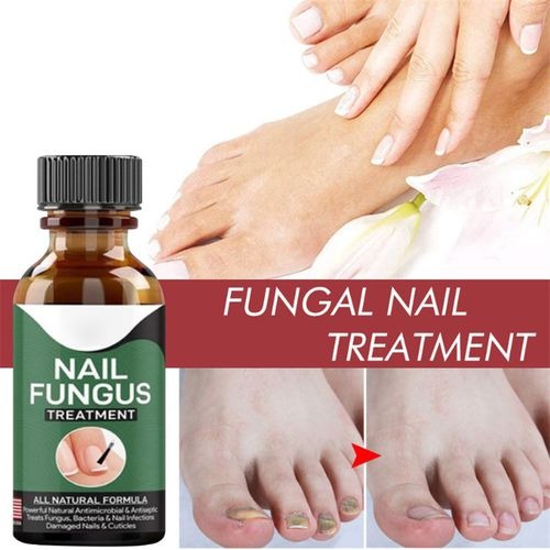 Nail Fungus Removal Gel