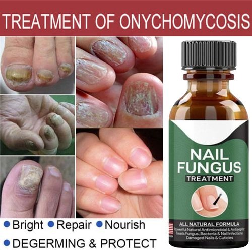 Nail Fungus Removal Gel