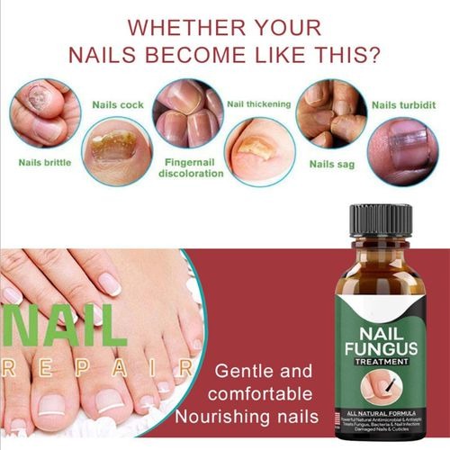 Nail Fungus Removal Gel